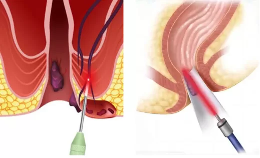 O Uso do Laser na Cirurgia Anal: Benefícios, Desafios e Considerações