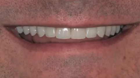 Os Dentes Contribuem para o Envelhecimento da Face?